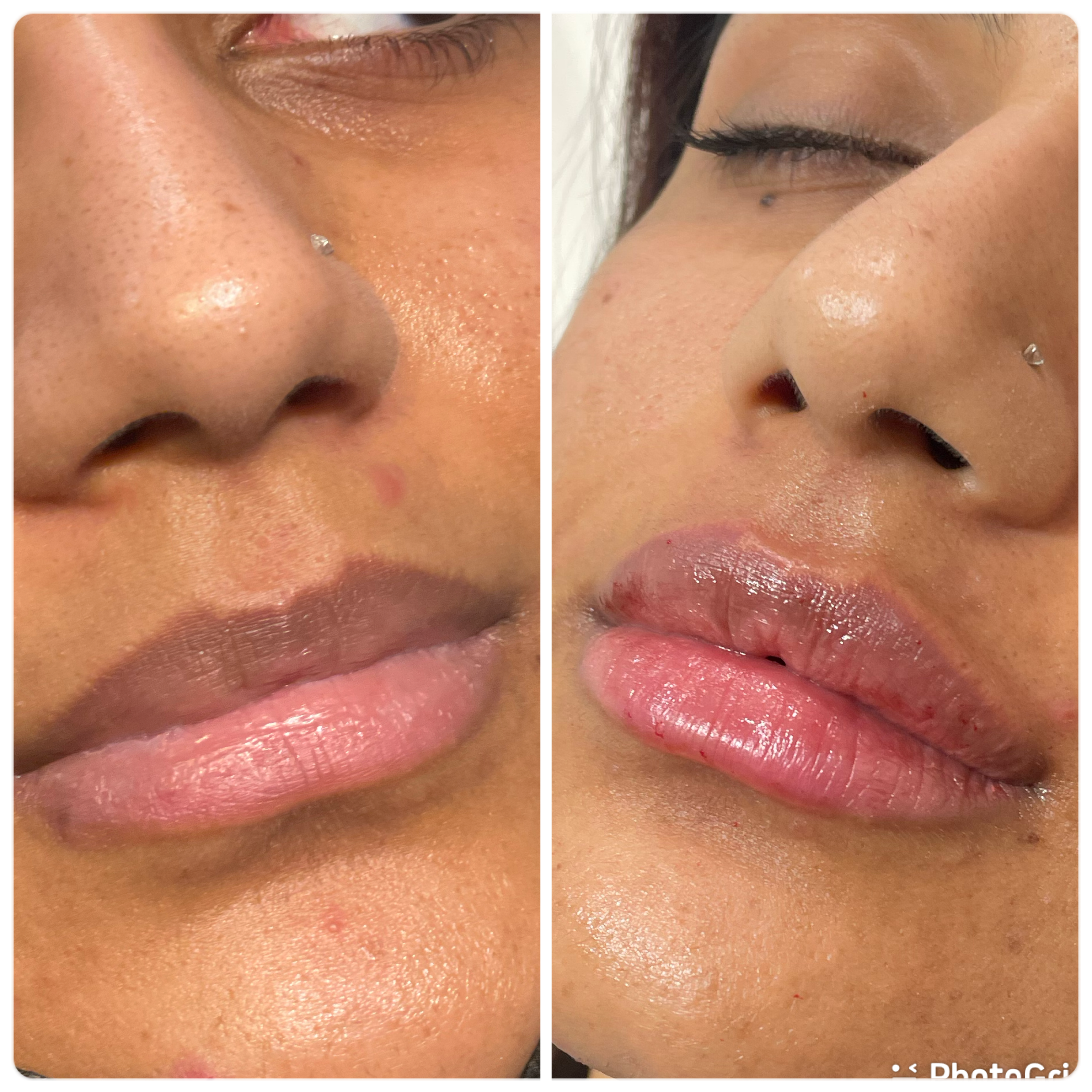 Not Every Lip Can Be Plump and Juicy After One Syringe